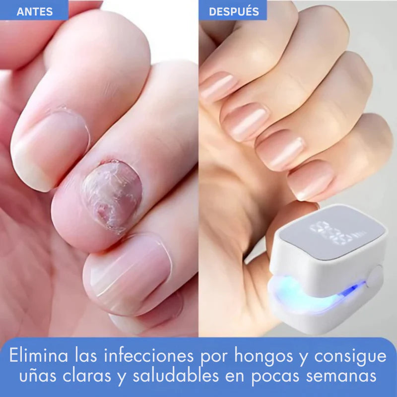 DISPOSITIVO LÁSER ANTIHONGOS PARA UÑAS–NAILCURE PRO™ | TRATAMIENTO EN CASA SIN DOLOR.