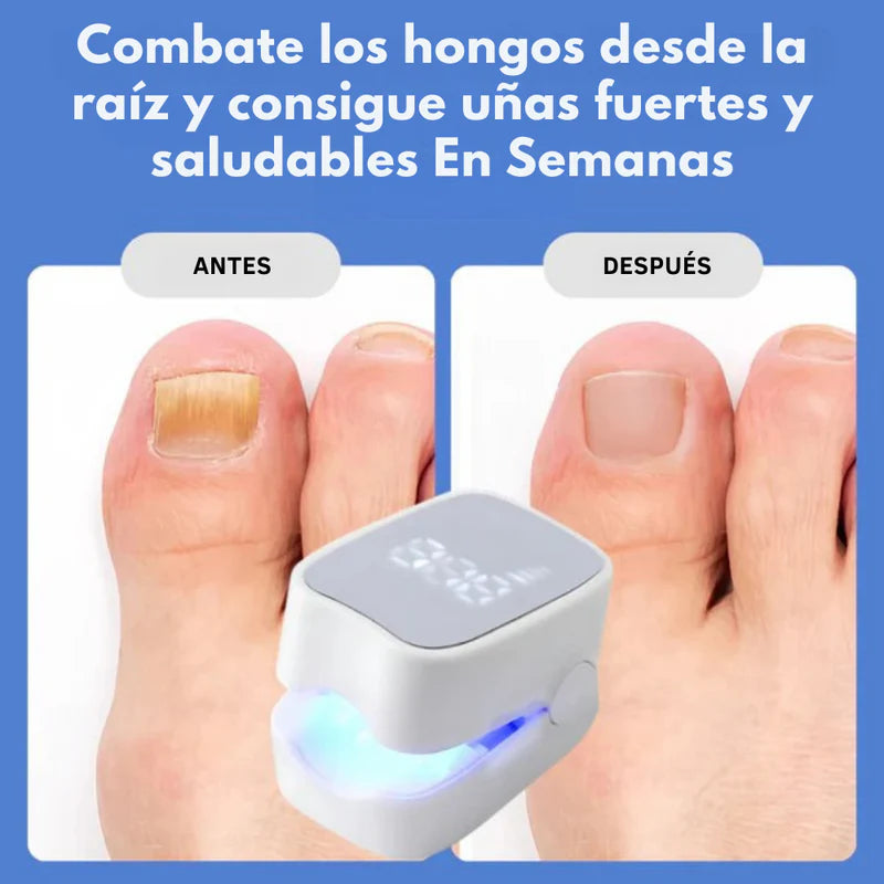 DISPOSITIVO LÁSER ANTIHONGOS PARA UÑAS–NAILCURE PRO™ | TRATAMIENTO EN CASA SIN DOLOR.