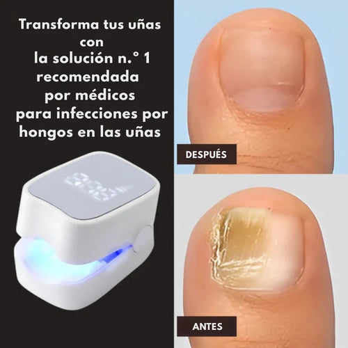 DISPOSITIVO LÁSER ANTIHONGOS PARA UÑAS–NAILCURE PRO™ | TRATAMIENTO EN CASA SIN DOLOR.